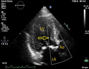 Sigmoid left ventricular hypertrophy as observed on transthoracic echocardiography.