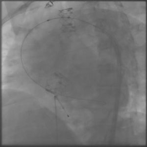 Fluoroscopy showing implantation of a second Edwards SAPIEN prosthesis and the embolized valve repositioned in the aortic arch.