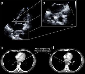 Top: transthoracic echocardiography, (a) apical 4-chamber view showing a mass to the rear of the left atrium and (b) zoom view on the mass; bottom: computed tomography of the chest, axial view, showing a mass constricting the distal esophagus.