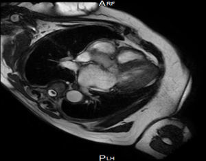 Cardiac magnetic resonance image showing basal interventricular septal hypertrophy.