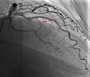 Coronary angiography image before alcoholic septal ablation showing the first septal coronary artery branch (arrow).