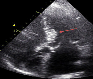 Myocardial contrast echocardiography image after infarction of the first septal coronary artery branch.