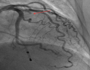 Coronary angiography image after alcoholic septal ablation showing proximal occlusion of the first septal coronary artery branch (arrow).