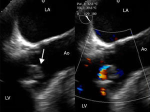 Transesophageal echocardiogram, long-axis aortic valve plane, demonstrating the presence of a vegetation in the aortic prosthesis (arrow). Ao: ascending aorta; LA: left atrium; LV: left ventricle.