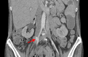 Thoracoabdominal computed tomography showing pseudoaneurysm (arrow) in the right iliac artery.