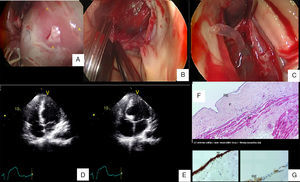 (A-C): Images captured during surgical resection of the cyst. (A): Cyst causing bulging of the interventricular septum and protruding into the left ventricular outflow tract; (B): intramyocardial location of the cyst; (C): cyst rupture and flow of clear fluid; (D and E): transthoracic echocardiogram after surgery showing a thin interventricular septum and delineation of the previous location of the cyst; (F and G): microscopic aspects of the cyst: (F): cyst wall, H & E stain ×100; (G): cytokeratin 5/6 ×400 (left) and vimentin ×400 (right): keratin and vimentin co-expression by the cells of the internal layer of the cyst. RE: internal cell layer of the cyst; F: fibrosis; M: myocardium.