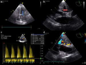 Transthoracic echocardiogram (4-chamber view) and transesophageal echocardiogram (120°) revealing a cardiac mass 63 mm×43 mm in size, occupying almost the entire left atrium (a and b), causing mitral valve obstruction (c) and flow acceleration within the left atrium (d).