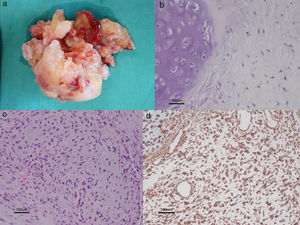 (a) Part of the heterogeneous irregular excised mass (5 cm×3 cm); (b) predominant pattern consisting of myxochondromatous tissue, mimicking common myocardial myxoma and mature lobular cartilage (H&E ×200); (c) intermingled in the myxoma pattern, highly proliferative areas consisting of fusiform and polygonal eosinophilic cells with nuclear atypia (H&E ×200); (d) atypical cells expressing cytoplasmic vimentin and immunonegative for CD3, S100 protein and CD68 (vimentin ×100).