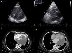 (a and b) Transthoracic echocardiogram (modified 4-chamber view) showing a left intraventricular mass measuring 59 mm×35 mm protruding into the left ventricular outflow tract, extending to the pericardium and infiltrating the left ventricular wall; (c and d) computed tomography angiography showing an intracardiac mass occupying the entire left atrium and part of the left ventricle, extending to the pericardium and compressing the inferior vena cava.