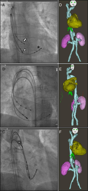 Fluoroscopic images in (A) anteroposterior (AP), (B) left anterior oblique (LAO) at 35°, and (C) right anterior oblique (RAO) at 30° views, showing the positioning of the His (arrow), coronary sinus (star) and ablation (arrowhead) catheters. Three-dimensional reconstructions were obtained after the procedure, showing suprarenal inferior vena cava agenesis, draining into the superior vena cava (blue), hepatic veins (green), heart (gold) and kidneys (purple), in AP, LAO and RAO views (D, E and F, respectively).