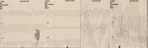 Electrocardiogram of clinical ventricular tachycardia (256 bpm).