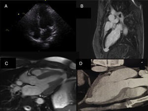 Multimodality imaging of the left ventricular apical aneurysm. (A) Echocardiogram, 4-chamber view, showing no remarkable changes; (B) cardiac magnetic resonance imaging with late gadolinium enhancement depicting myocardial delayed enhancement restricted to the wall of the left ventricular apical aneurysm; (C) cardiac magnetic resonance imaging at end-systole demonstrating the lack of systolic thickening of the left ventricular apical aneurysm wall; (D) computed tomography image of the left ventricle clearly showing the thinning of the left ventricular aneurysm wall compared to the surrounding myocardium.