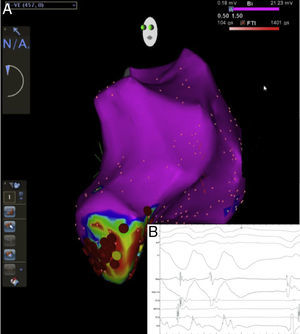 (A) Three-dimensional electroanatomic image of the left ventricle acquired during electrophysiological study. It can be seen that the ventricular tachycardia was localized to the apical aneurysm and the radiofrequency applications; (B) diastolic potentials at the ablation catheter (MAP), and interruption of ventricular tachycardia during radiofrequency applications.