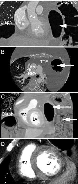 Cardiac computed tomography. (A) Coronal plane with marked herniation of the abdominal contents into the left hemithorax (white arrow); (B) the corresponding axial plane with bowel loops extending up into the thorax to the level of the main pulmonary artery; (C) coronal volume-rendered image of the bilateral diaphragmatic elevation and bowel loops within the thoracic cavity; (D) contrast-filled cardiac chambers with a thin and hypoperfused inferior wall, as typically seen in Duchenne muscular dystrophy. Ao: aorta; Diaph: diaphragm; LV: left ventricle; RA: right atrium; RPA: right pulmonary artery; RV: right ventricle; TTF: transthoracic fat.