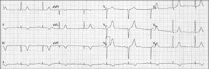 Eletrocardiograma: ritmo sinusal com frequência cardíaca 60bpm, ondas Q de novo e ondas T negativas profundas nas derivações inferiores.
