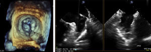Transesophageal echocardiographic images of the stenotic mitral valve and the thrombus-free left atrial appendage with spontaneous inner contrast.