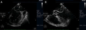 Transesophageal echocardiogram. (A) 2-chamber view: saccular bulge (aneurysm) on the atrial side of the anterior mitral valve leaflet (arrow); (B) 5-chamber view: bilobular image (aneurysm) on the atrial side of the anterior mitral valve leaflet (arrow).