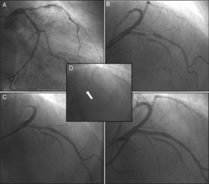 Coronary angiography showing severe disease of the mid left anterior descending (LAD) artery, involving the bifurcation with the first major septal branch (Medina 1,1,1) (A and B); after angioplasty of the first septal branch with a drug-eluting balloon and LAD predilation (C), a bioresorbable scaffold was implanted in the mid LAD using the Szabo technique (D and E).