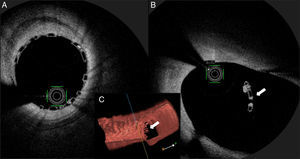Intracoronary optical coherence tomography revealing optimal strut apposition (A) and the small anchoring strut (white arrow) floating in the circumflex ostium; (B) two-dimensional view from the left anterior descending (LAD); (C) three-dimensional reconstruction, view from LAD.