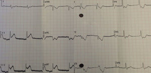 Eletrocardiograma após início dos sintomas.