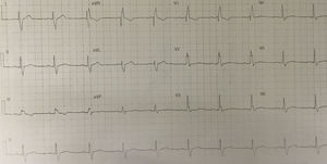 Eletrocardiograma após coronariografia.
