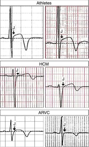 Derivação V3 aumentada em diferentes condições clínicas. Cima: notar a elevação do ponto J antecedendo a inversão da onda T (ambos os painéis de atletas saudáveis). Meio: notar a elevação do segmento ST (sem elevação do ponto J) antecedendo a inversão da onda T (ambos os painéis de doentes com miocardiopatia hipertrófica). Em baixo: notar a ausência de elevação do ponto J antecedendo a inversão da onda T (ambos os painéis de doentes com displasia arritmogénica do ventrículo direito). Setas indicam «ponto J». Adaptado de Calore et al.11.