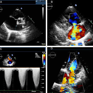 Large ostium secundum type atrial septal defect (A), severe tricuspid regurgitation (B and C) and moderate mitral regurgitation (D).