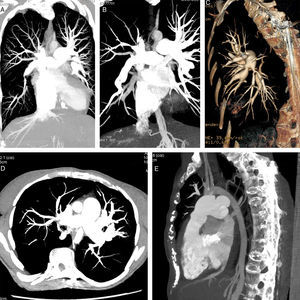 Severe stenosis at the origin of most of the lobar pulmonary arteries and diffuse stenosis of the rest (A-D), and underdevelopment of the aortic arch (E).