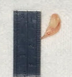 Surgical specimen.