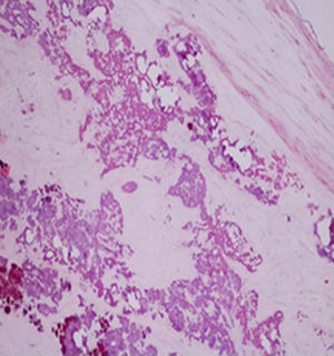Histology showing dystrophic calcifications and fibrosis, with no other changes and no evidence of inflammation or tumor.