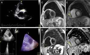 (A) Two-dimensional transthoracic echocardiography, modified short-axis view at the sub-tricuspid level, depicting a well-defined right ventricular mass (*) and part of the right coronary artery course along the atrioventricular groove (arrow); (B) three-dimensional (3D) transthoracic echocardiography, live 3D bird's eye view, modified 4-chamber view, showing a homogeneous and delimited ovoid mass (*) on a sub-tricuspid position; (C and D) mid-ventricular short-axis T1 and fat sat T2-weighted turbo spin-echo sequences, respectively, showing a hypointense homogeneous right ventricular mass (*) with no fat tissue; (E and F) mid-ventricular short-axis T1 post-contrast and phase-sensitive inversion recovery sequences, respectively, illustrating a small hyperintense core (arrowhead) inside the mass (*).