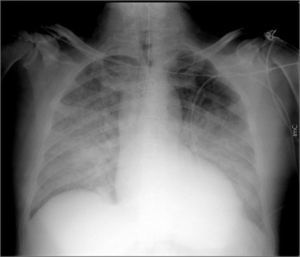 Chest X-ray showing cephalization of pulmonary veins and indistinctness of the vascular margins. The heart is enlarged.