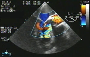 Transesophageal echocardiography, long-axis mid-esophageal view, showing severe eccentric aortic regurgitation.