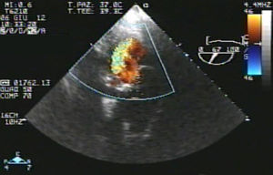 Transesophageal echocardiography, transgastric view.