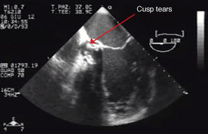 Transesophageal echocardiography, 4-chamber mid-esophageal view, showing prosthesis degeneration and cusp tears (red arrow).