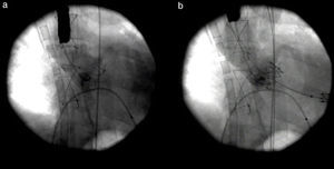 Aortic angiography before (a) and after (b) transcatheter aortic valve implantation.