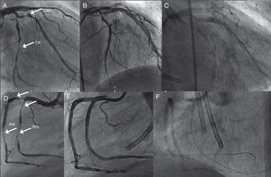 Coronary angiography showing (A) 85% long stenosis of the first obtuse marginal branch and 80% stenosis of the distal circumflex (CX) artery (arrows); (B) these lesions treated with two and one drug-eluting stents (DES), respectively; (C) the CX with gadolinium contrast after six months; (D) early right coronary artery (RCA) bifurcation, 90% stenosis of the right posterolateral branch (RPL) (arrows), 90% at the origin of the posterior interventricular artery (PIA) and 80% distal to the PIA; (E) these lesions treated with two DES in the RPL, one DES at the origin of the PIA and another in the distal segment of the PIA; (F) coronary angiography of the RCA with gadolinium contrast after six months. CX: circumflex artery; OM1: first obtuse marginal branch; PIA: posterior interventricular artery; RPL: right posterolateral branch.