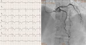 Left: resting electrocardiogram with negative T waves and prolonged QT interval; right: intermediate coronary stenosis in the mid left anterior descending artery.