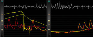 Left: afterdepolarizations and initiation of polymorphic ventricular tachycardia (VT) following adenosine injection. Note the absence of catheter damping or ischemia; right: self-termination of the VT, with restoration of blood pressure and minimal separation between pressure curves (Pd, red curve; Pa, yellow curve). Further adenosine injections demonstrated a minimum fractional flow reserve of 0.93 (non-significant).
