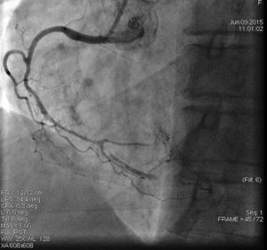 Second angiogram of the right coronary artery, showing a wider false lumen in the posterior descending artery, greater true lumen compromise and worse flow to the posterolateral branches.
