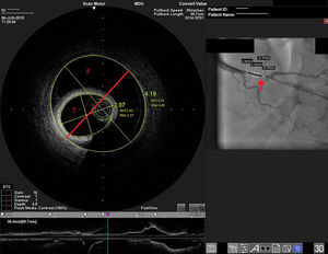 Distal right coronary artery (RCA) viewed by optical coherence tomography (OCT). Location of the OCT frame within the RCA is easily identified on the angiogram (arrow). Although the angiogram projection eventually captured the vessel at its smallest diameter (red line), this should be 4.03 mm as measured by OCT. By angiography the largest diameter of the segment is 2.1 mm. This suggests that the false lumen (F) is filled with a clear fluid, but not contrast, since on the angiogram only the true lumen (T) is visible, corresponding to the 2.07 mm mean true luminal diameter measured by OCT. Moreover, on OCT the catheter can be seen at the center of the vessel, but touching the intimal wall, while on the angiogram it appears adjacent to the wall, suggesting that only the true lumen is visible.