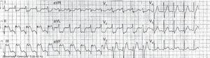 Teletransmitted electrocardiogram demonstrating inferior and inferobasal ST-elevation myocardial infarction and suggesting closure of the right coronary artery.