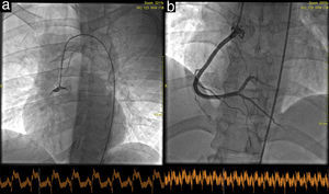 Acute thrombosis of the right coronary artery, TIMI flow 0 (a); status following stent implantation, TIMI flow 3 (b).