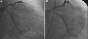 (A) Complete occlusion of the large second obtuse marginal branch; (B) successful intracoronary aspiration by suction catheter; the lesion was fully reperfused.
