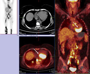 Positron emission tomography/computed tomography image of the patient with diffuse large B-cell lymphoma showing dorsal focal 18F-fluorodeoxyglucose accumulation in the myocardium (white arrows).