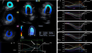 Apical 4-chamber (A) and 2-chamber (B) views and short-axis views (C3, C5, C7) at different levels of the left ventricle (LV) extracted from the three-dimensional (3D) echocardiographic dataset in the patient with diffuse large B-cell lymphoma. The 3D model of the left ventricle and calculated LV volumetric and functional characteristics are also presented together with LV rotational (D) and strain (E) parameters. Apical (white arrow), midventricular and basal (dashed arrow) LV rotations were demonstrated to be in the same counterclockwise direction, confirming the near absence of LV twist (rigid body rotation). Some segmental LV strains were also found to be reduced. EDV: end-diastolic volume; EF: ejection fraction; ESV: end-systolic volume; LV: left ventricular.