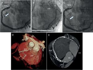 (A and B) Coronary angiography showing a single coronary artery (SCA) originating from the right coronary sinus, also supplying the territory of the left anterior descending (LAD) and circumflex (CX) arteries, and thrombotic occlusion of an acute marginal branch (A, arrow); (C) primary percutaneous coronary intervention recovering distal TIMI 3 flow in the culprit vessel (arrow); (D and E) multislice computed tomography reconstruction. After its origin, the main trunk of the SCA crosses the base of the heart to supply the contralateral coronary artery. Immediately after the origin of this main trunk, it also gives off a small vessel that reaches the anterior interventricular sulcus anteriorly to the aorta (AO) and pulmonary artery (PA) to supply the proximal LAD territory.