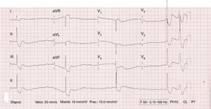 Complete atrioventricular block with premature ventricular complex.