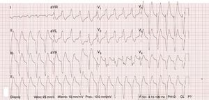 Ventricular tachycardia.