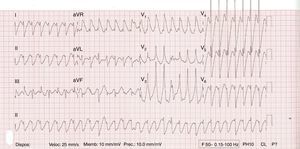 Bidirectional ventricular tachycardia.